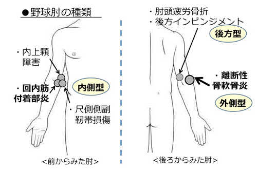 野球肘の種類