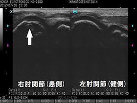 外側野球肘発症時