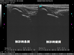 内側野球肘検診時